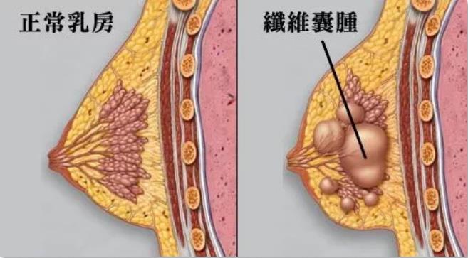 粉红天使告诉你关于“乳腺囊肿”的真相与谎言！